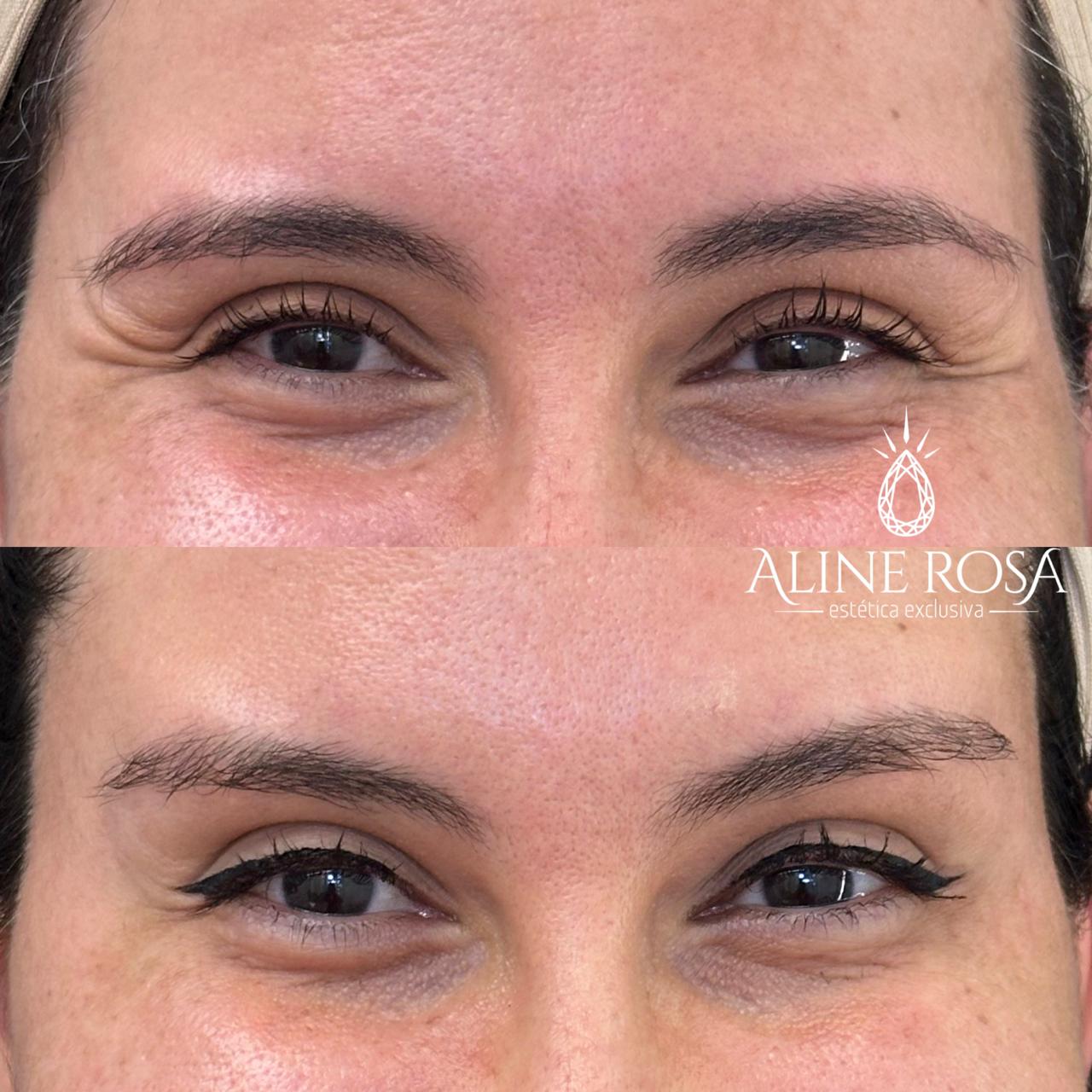 Botox Terço Superior Feminino